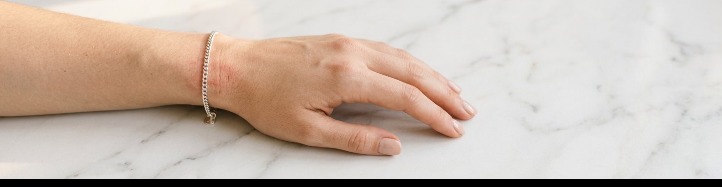 Symptômes allergie bijoux : rougeurs et démangeaisons au poignet